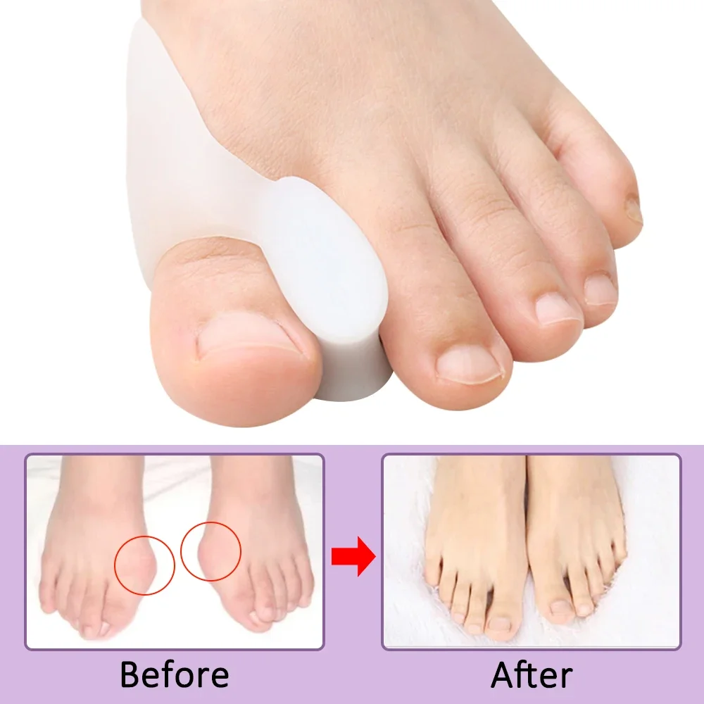 Separador de gel juanete alivio hallux valgus - imagen 5