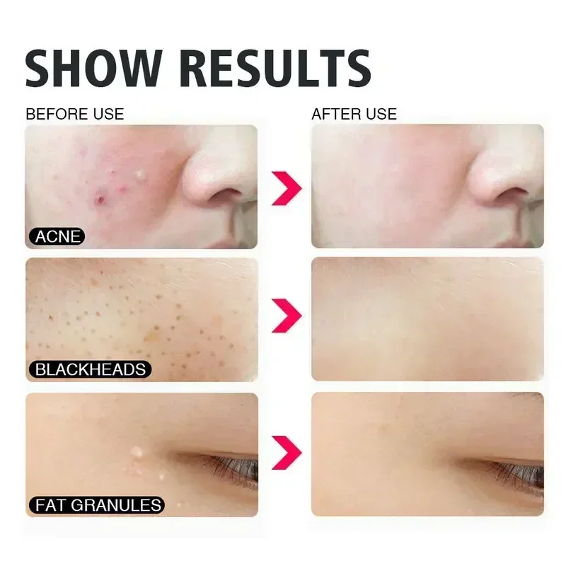 Extractor de puntos negros con cuchara rosa para cuidado facial - imagen 3