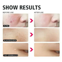 Extractor de puntos negros facial de oro rosa, herramienta