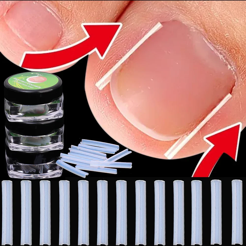 Corrector de uñas encarnadas con parches adhesivos elásticos - imagen 3